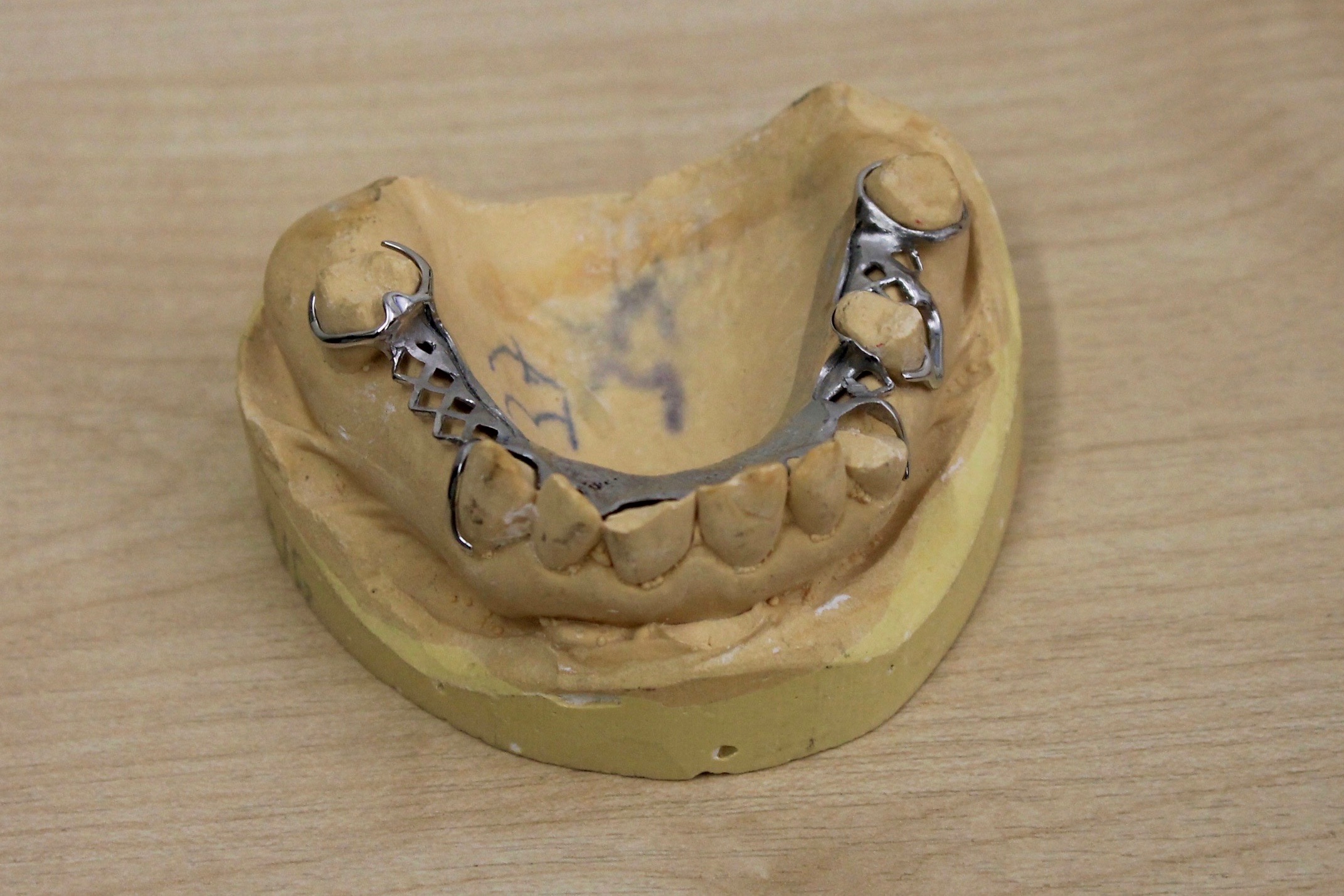 Chrome Cobalt Denture