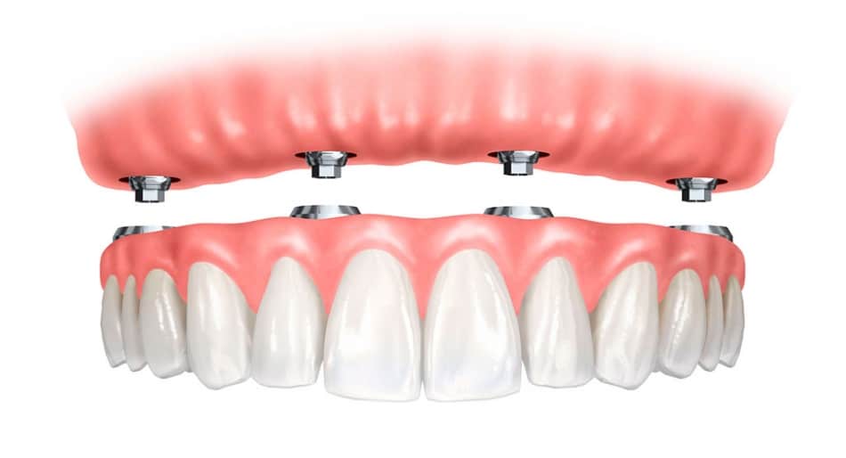 Implant Dentures