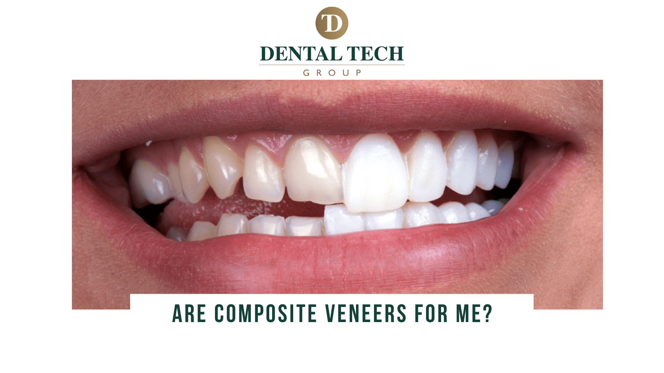 Composite veneers